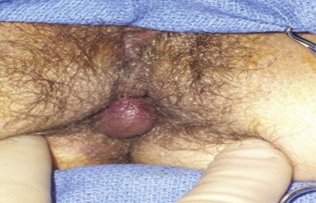 External haemorrhoids