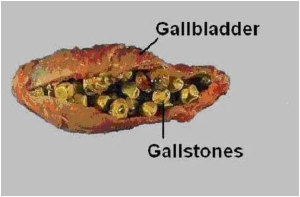 Gallstone Disease |