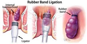 Rubber Band Ligation