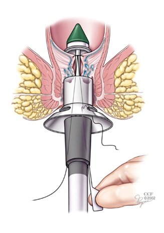 Staple Haemorrhoidectomy